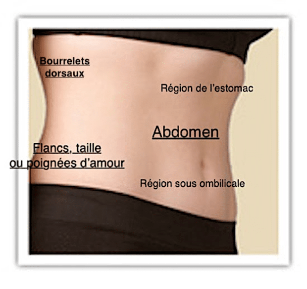 Schéma des zones de l'abdomen pouvant être traitées par lipoaspiration