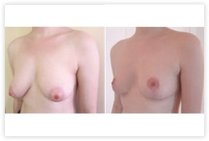 Résultat de chirurgie de ptose mammaire