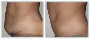 Abdominoplastie avant/après