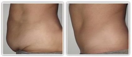 Abdominoplastie avant/après