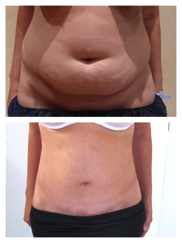 abdominoplastie-poids