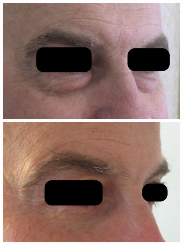 Résultat chez un homme d'une chirurgie esthétique des paupières inférieures par voie conjonctivale pour un rajeunissement naturel du regard