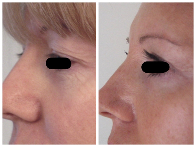 avant après blépharoplastie supérieure