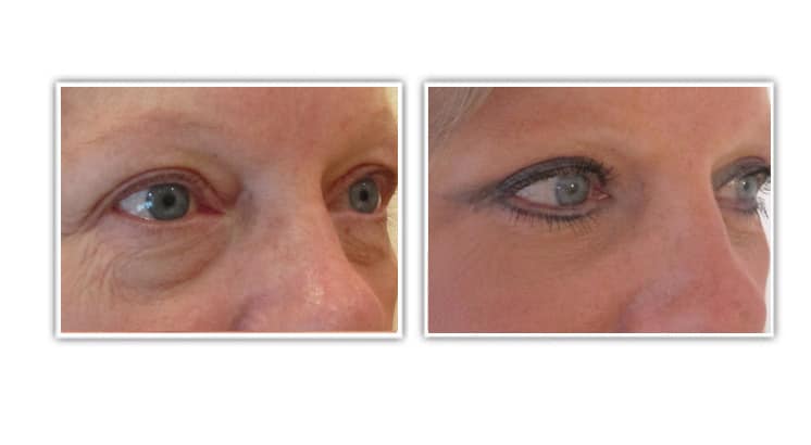 Blépharoplastie supérieure et inférieure par voie sous-cilaire