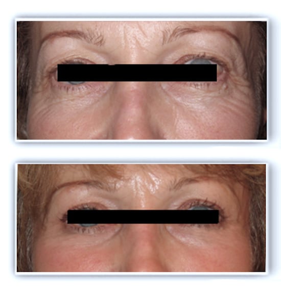 Excédent de peau au niveau des paupières supérieures (dermatochalasis) et excédent mixte cutané et graisseux au niveau des paupières inférieures: blepharoplastie supérieure et inférieure réalisée sous anesthésie locale pour rafraichissement naturel du regard