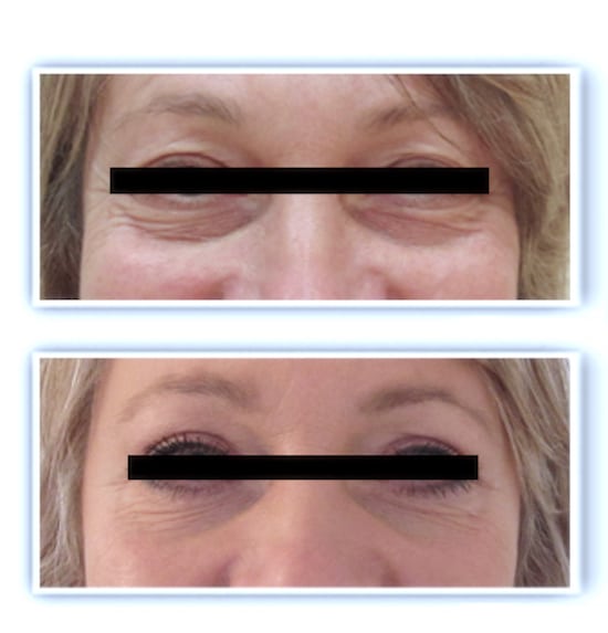 Résultat d'une chirurgie esthétique des paupières traitant l'exces de peau au niveau des paupieres supérieures et les poches graisseuses sous les yeux avec l'excédent du peau au niveau des paupieres inférieures