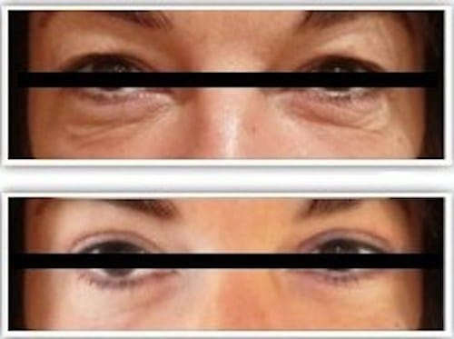 Photo avant/après d'une blépharoplastie supérieure et inferieure pour rajeunissement naturel du regard: traitement des paupières tombantes et par des poches graisseuses qui donnaient un regard fatigué