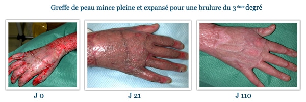 Brûlure du 3ème degré de la main, traitement par greffe de peau mince