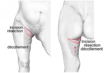 cicatrice horizontale de lifting des cuisses