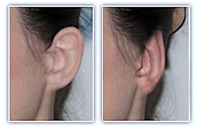 decollement-averé-oreilles-pris-en-charge
