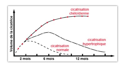 Evolution de la cicatrisation normale et des cicatrices pathologiques (hypertrophiques, chéloides) - source Latarjet, Echinard