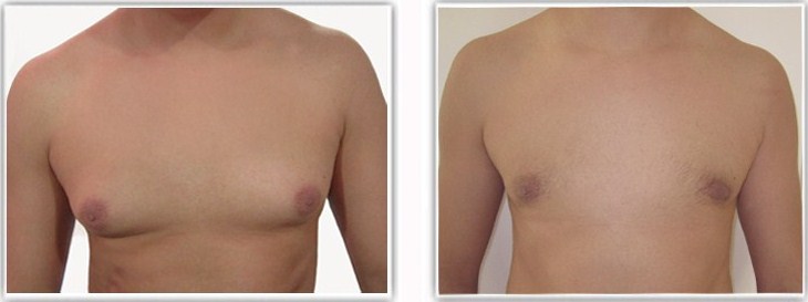 adipomastie traitée par lipoaspiration