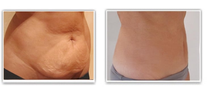Mini-abdominoplastie avec liposuccion du ventre dont la cicatrice est cachée par le maillot