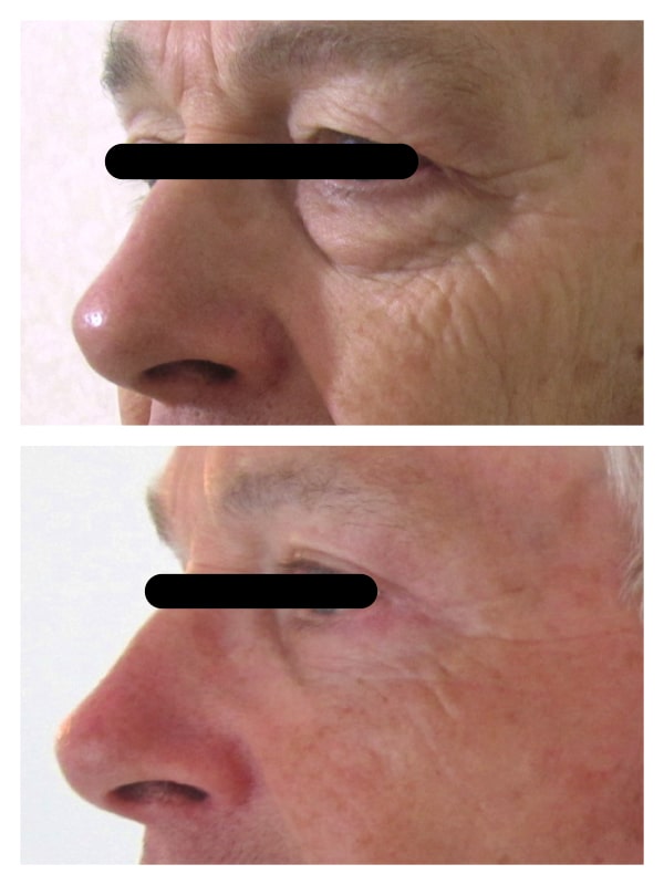 résultat blépharoplastie supérieure et inférieure homme