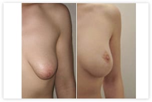 Correction de seins tubéreux avant/après