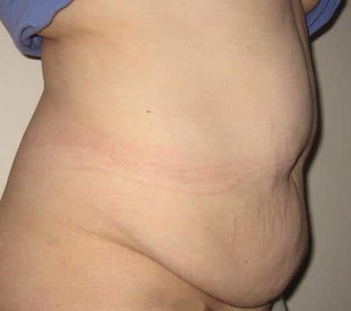 tablier abdominal