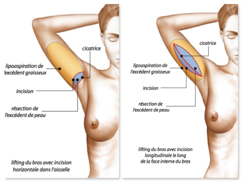 types-cicatrices-lifting-bras