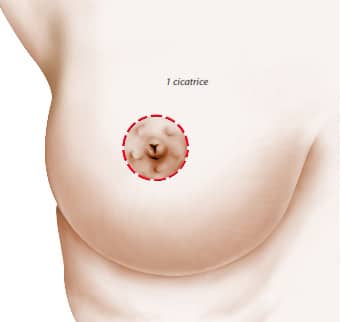 Correction de ptose mammaire par cicatrice péri-aréolaire (ou technique du « round block »)