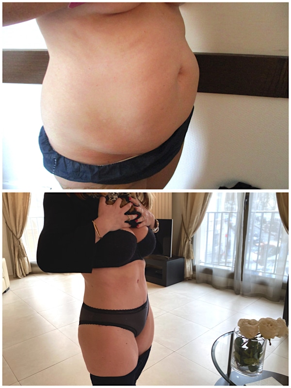 abdominoplastie avec liposuccion du ventre