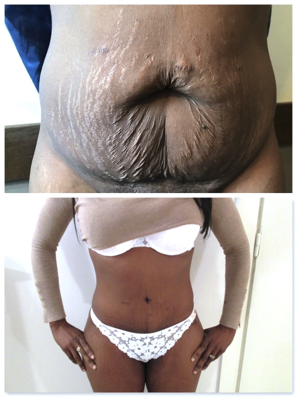 Resultat vue de face
