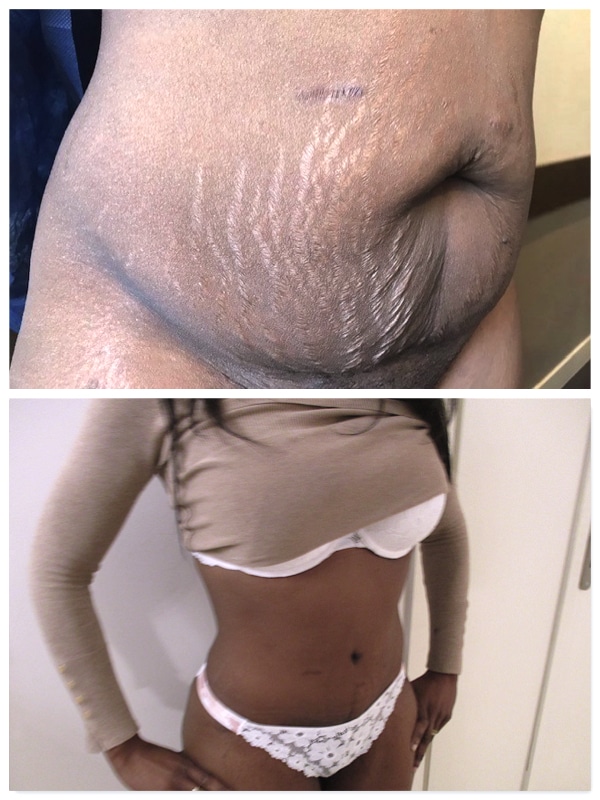 Resultat abdominoplastie avec correction diastasis et liposuccion du ventre