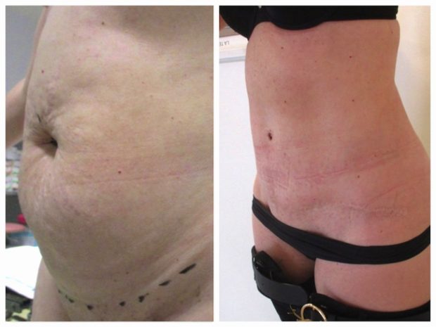 Photo de résultat avant/après d'une chirurgie esthétique du ventre : abdominoplastie
