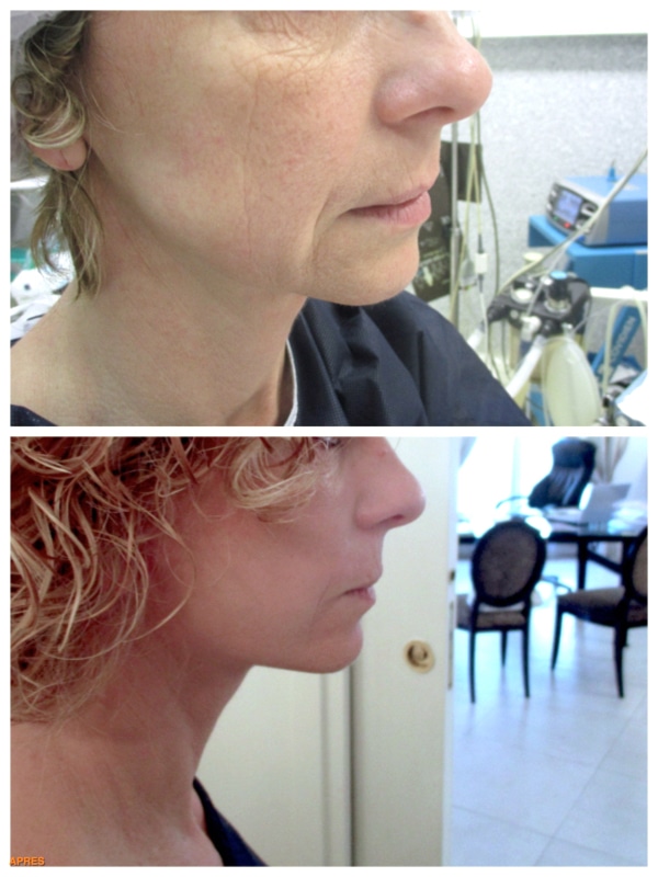 Résultat d'un lifting du visage cervico-facial chez une femme souhaitant un rafraichissement de son visage