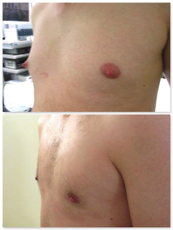Résultat d'un traitement de gynecomastie mixte avec turgescence aréolaire