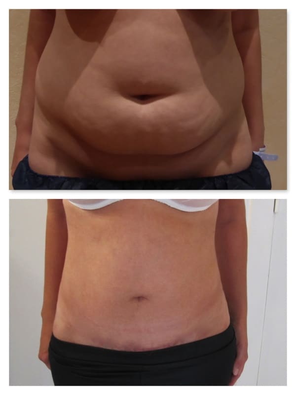 Résultat d'une abdominoplastie avec lipoaspiration après amaigrissement