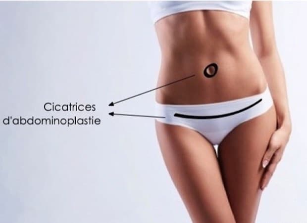 Disposition des cicatrices après une abdominoplastie