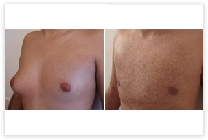 Gynécomastie asymétrique : photo avant/après la correction bilatérale pour une poitrine plate