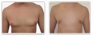 Gynécomastie graisseuse pure traitée par liposuccion chez un homme de 32 ans