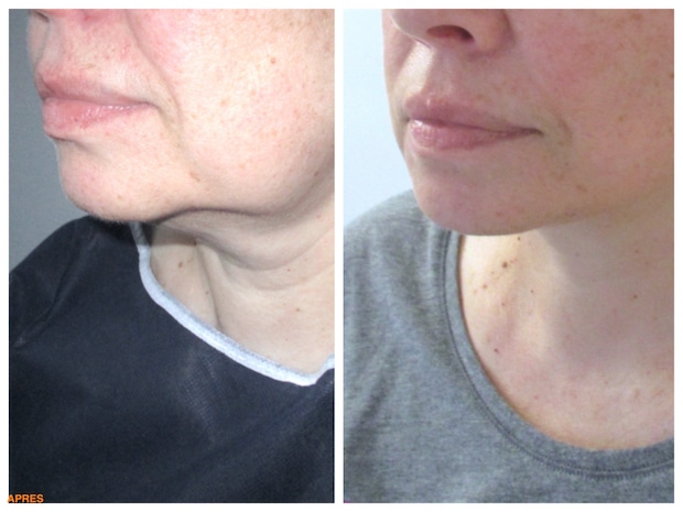 Résultat avant-après d'un lifting du bas du visage chez une femme traitant le relâchement. Un lifting localisé de restaurer l'ovale et l'angle du cou pour un résultat naturel
