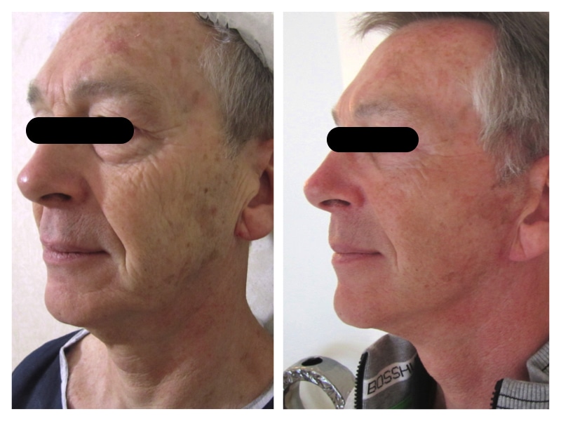 Résultat avant/après d'un lifting cervico-facial chez un homme avec blepharoplastie supérieure et inférieure pour un rajeunissement global du visage