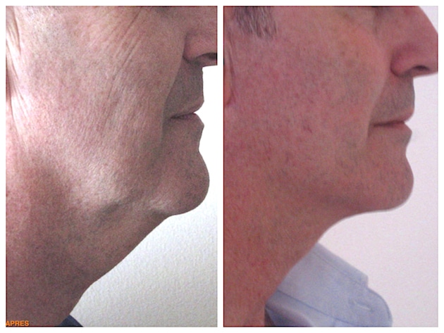 Résultat d'un lifting du visage chez un homme avec liposuccion du cou traitant le double menton et les bajoues