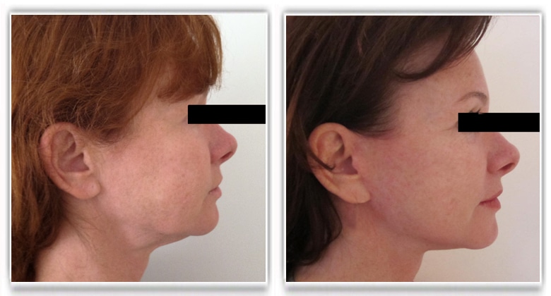 Photo avant après lifting du visage