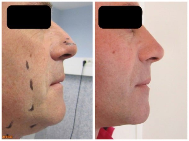 Résultat avant/après mini-lifting du visage chez un homme avec lipoaspiration du cou en raison du double menton et rhinoplastie