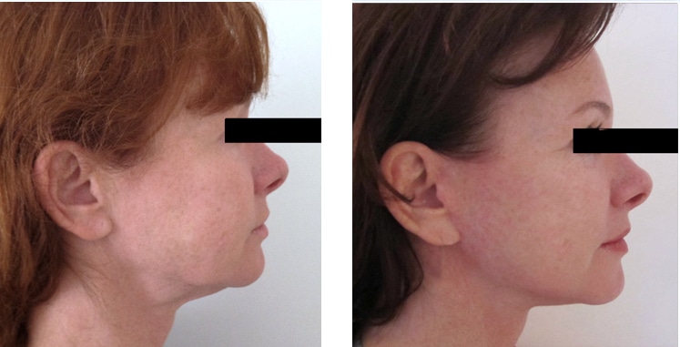 Photo avant après d'un lifting du visage chez une femme de 50 ans