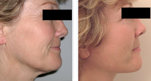 Photo avant/après d'un lifting du visage chez une femme traitant le relâchement de la peau du cou et des joues