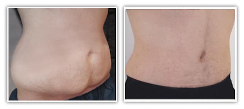Résultat d'abdominoplastie complète chez l'homme