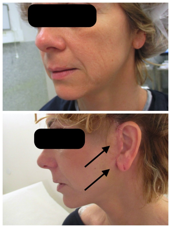Lifting du visage chez une femme avec aspect des cicatrices