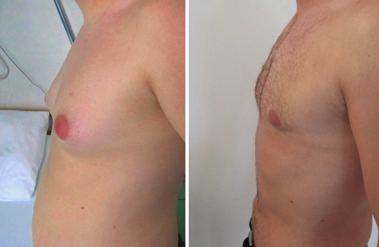 Resultat de correction de gynecomastie associée à une liposuccion abdominale