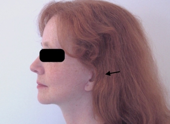 Résultat précoce chez une femme d'un lifting cervico-facial superficiel traitant les bajoues et le cou