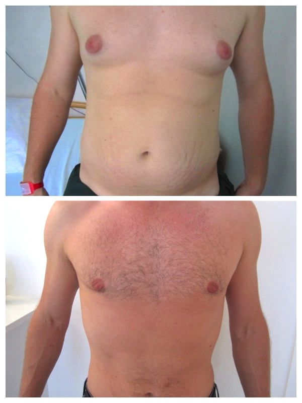 lipoaspiration ventre et poitrine homme
