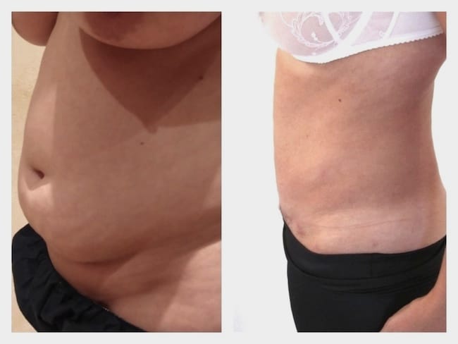 Resultat de mini-plastie abdominale avec liposuccion