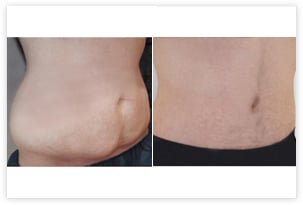 Résultat d'abdominoplastie complete c'est à dire avec transposition ombilicale chez un homme