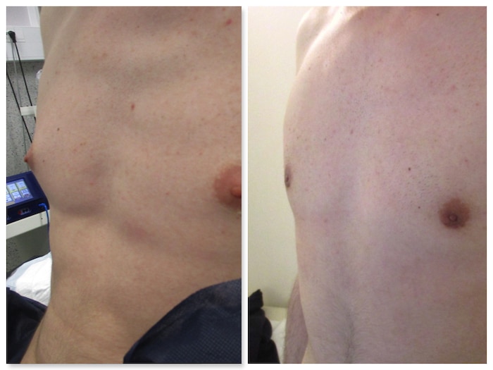 Résultat d'une operation traitant une gynecomastie modérée appelée turgescence aréolaire ou protrusion aréolair