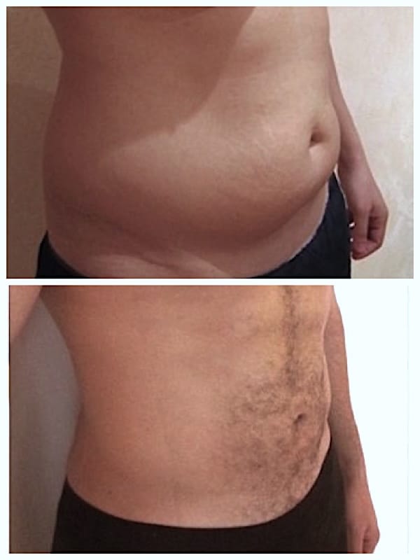 lipoaspiration du ventre chez un homme