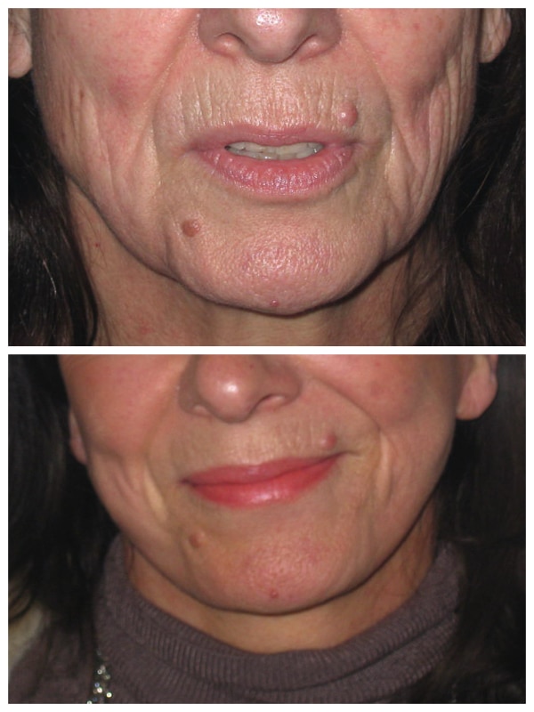 Résultat relâchement cutané d'un visage fatigué corrigé par lifting jugo-cervical superficel sans tension permettant une rajeunissement naturel