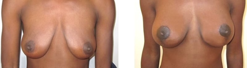 augmentation mastopexie